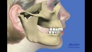 Herbst appliancemove lower jaw forward [upl. by Allemaj]