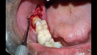 Surgical Extraction of Horizontally Impacted Mandibular Right 3rd Molar Case By Dr Akash Akinwar [upl. by Notsle]