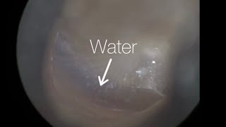 30  Shower Water Trapped in Ear Microsuctioned using the WAXscope®️ [upl. by Libbey]