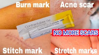 Contractubex gel  How to Remove ScarBest for Acne scar  Burn mark  Stretch mark  Stitch mark [upl. by Airekat]