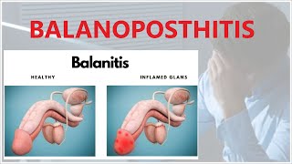 BALANOPOSTHITIS is a condition that affects the penis [upl. by Aihseya]