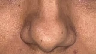 Bulbous Nose Rhinopalsty a classical Tip plasty surgical steps [upl. by Kwasi]