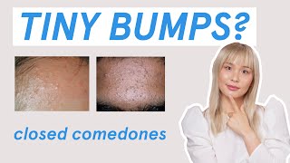 Why those tiny bumps AREN’T fungal acne [upl. by Etnaud775]