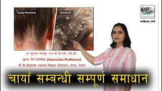 Seborrhoeic Dermatitis Dandruff in Nepali  छाला राेग विशेषज्ञ  Dr Suchana Marahatta  DIP नेपाली [upl. by Santoro]