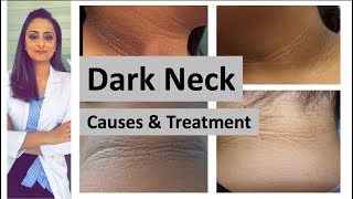 dark neck  causes treatment  Home remedies  Dermatologist Dr Aanchal Panth [upl. by Ikcin]