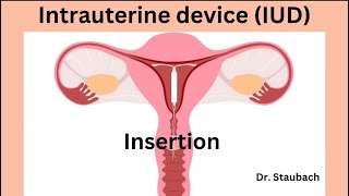 IUD Insertion What You NEED To Know ACTUAL FOOTAGE [upl. by Aicilef887]