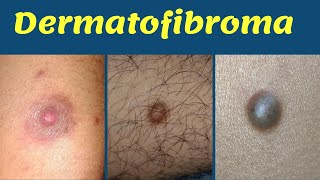 Dermatofibroma treatment hard bump on leg  चमड़ी में सख़्त गाँठ का कारण  इलाज  Dr Uttam Lenka [upl. by Ahsikam]