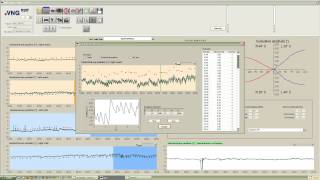 eVNG Caloric Settings [upl. by Addia]