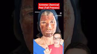 ALARMING CHEMICAL PEEL  Full Phenol Peel Process shorts [upl. by Dadirac392]