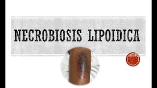 Necrobiosis Lipoidica [upl. by Leissam882]