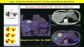 Neuroendocrine Tumors Diagnosis amp Treatment w Peptide Receptor RadiotherapyPRRT Dr Baum 2of2 [upl. by Enytsuj206]