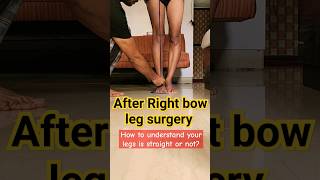 how to know bow legs straight after surgery bowlegs knockknees genuvarum [upl. by Llenrahc]