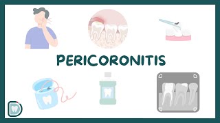 Relief from Wisdom Tooth Pain Understanding Pericoronitis [upl. by Aubine]