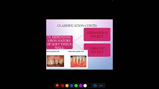 PERIODONTAL POCKET [upl. by Enitsyrhc126]