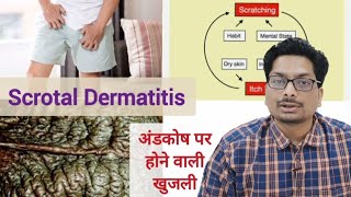 अंडकोष पर होने वाली खुजली का कारण  Part 1 Scrotal Dermatitis  Scrotal Eczema scrotaldermatitis [upl. by Brigit]