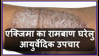 Health Tips एक्जिमा का रामबाण घरेलु आयुर्वेदिक उपचार  Charm Rog  Eczema ka Gharelu Upchar [upl. by Whallon36]