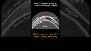 Skull bone structure 2 CT Brain Anatomy Skull Bones amp Sutures radiologychannel007 [upl. by Bilbe]