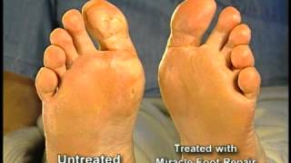 Miracle Foot Repair WMV 480p 4x3 [upl. by Kris]