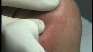 Electrolysis treatment of chin hairs [upl. by Evangelin525]