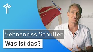 Sehnenriss an der Schulter Warum Sie Ihre Schulterschmerzen rechtzeitig behandeln lassen sollten [upl. by Valerie]