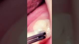 Bacho ki daad mein masala kaise bhara jata hai mandibular milk molar filingdentition🦷 [upl. by Ecniv577]