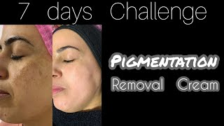 how To Get Rid Of Pigmentation  samundri jhag K Fayde  pigmentation removal Cream [upl. by Oyam]