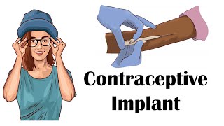 Contraceptive Progesterone Implant  Uses Mechanism Of Action Adverse Effects Contraindications [upl. by Tarrance]