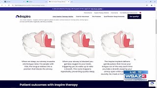 Inspire sleep apnea treatment [upl. by Ahsinor688]