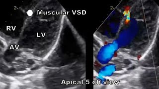 Types of VSD echocardiography [upl. by Dmitri]