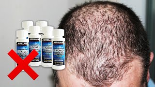 Dont Use MINOXIDIL Before Watching This – It Does NOT Prevent Hair Loss [upl. by Kuebbing198]