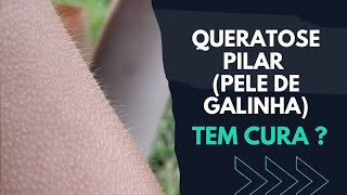 QUERATOSE PILAR PELE DE GALINHA TEM CURA  SAIBA [upl. by Cerracchio797]