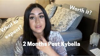 2 Months Post Kybella  What is the KYBELLA experience like [upl. by Ayotas]