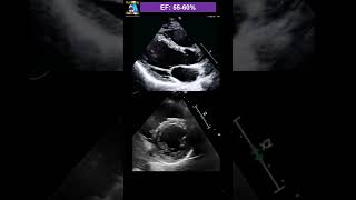 eyeball Guessing Ejection fraction [upl. by O'Dell33]