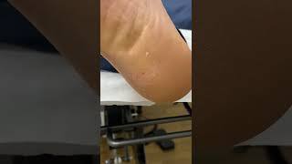 Heel Corn Removal By Podiatrist  Watch as our podiatrist removes a very painful and stubborn corn f [upl. by Libna]