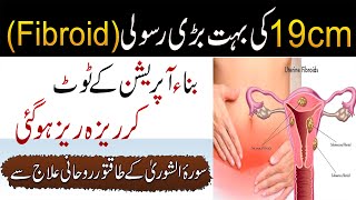 Baghair Operation Rasoli Ka Khatma  Surah AshShura Ka Powerful Amal  Fibroid Treatment From Quran [upl. by Anaidni]