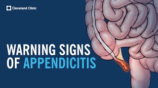 Warning Signs of Appendicitis [upl. by Cosimo]