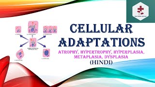 Cellular AdaptationsAtrophyHypertrophyHyperplasiaMetaplasia DysplasiaPathophysiologyHindi [upl. by Eahsat]