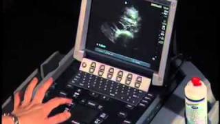 How To Abdominal Ultrasound  Aorta Measurements [upl. by Claudianus289]