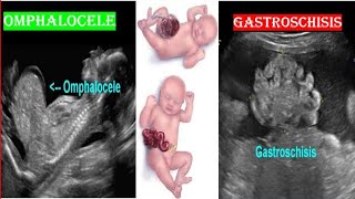 Omphalocele VS Gastroschisis on Ultrasound [upl. by Arola]