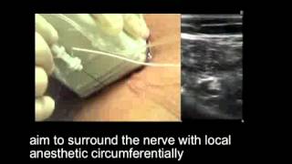 Popliteal Sciatic Nerve Block  Out of Plane Approach [upl. by Krahling]