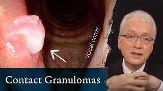 Contact Granulomas or Contact Ulcers [upl. by Edlitam]