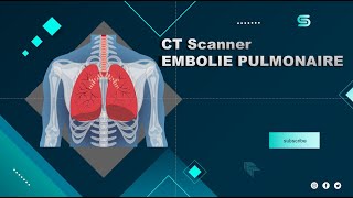 CT Scanner EMBOLIE PULMONAIRE  Partage de pratiques [upl. by Egrog]