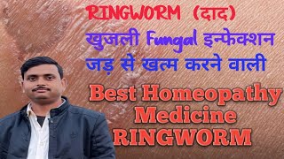 Homeopathic Ringworm Treatment Exposed दाद जड़ से खत्म [upl. by Oberheim]