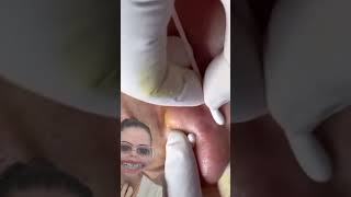 Blackheads Removal  Acne Treatment and Very Satisfying Satisfying Pimple pop blackheads [upl. by Port]