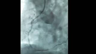 Ostial RCA stenting  90 seconds guide [upl. by Aney]