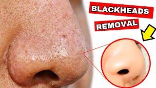 How To Remove Blackheads And Clogged Pores From Your Nose Permanently [upl. by Arahat101]