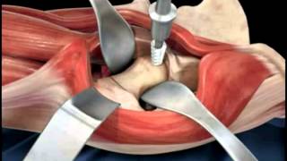 Hip replacement surgery techniques  Dr Scott Devinney [upl. by Perlman]