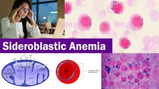 Sideroblastic Anemia  Clear amp Complete Explain [upl. by Eda160]