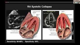 Drs Choi Ayres Davila  Sono  Echo Pearls Tamponade and Aortic Dissection [upl. by Llennod]