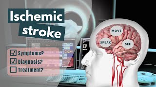 Ischemic Stroke Animation  Symptoms diagnosis treatment amp prognosis [upl. by Frum607]